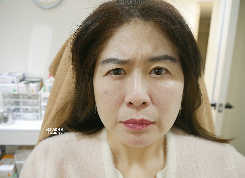 「粹究美學診所」皇家肉毒揮別紋路更持久自然 「粹究美學診所」皇家肉毒揮別紋路更持久自然