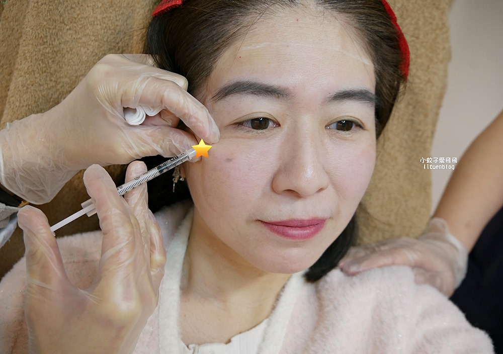 「粹究美學診所」皇家肉毒揮別紋路更持久自然 「粹究美學診所」皇家肉毒揮別紋路更持久自然